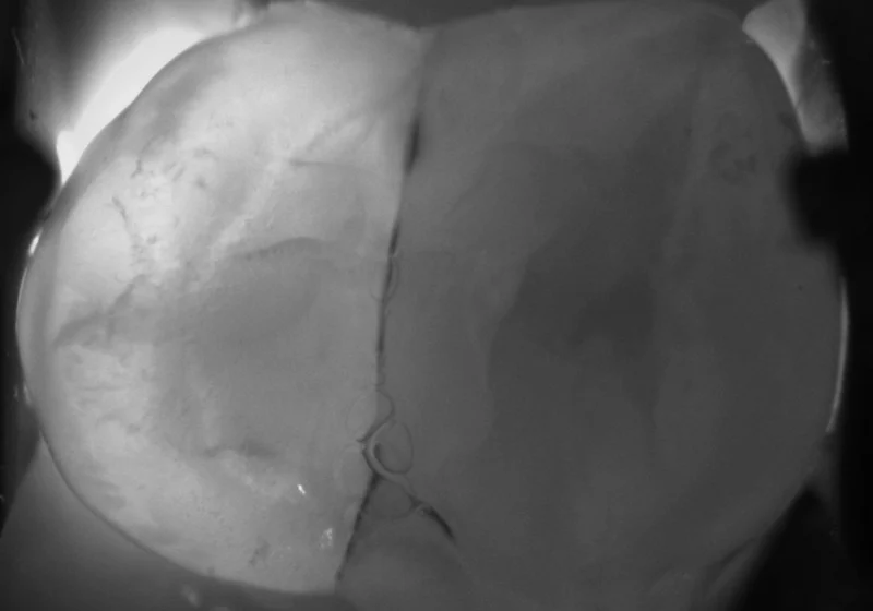 Cracked Teeth