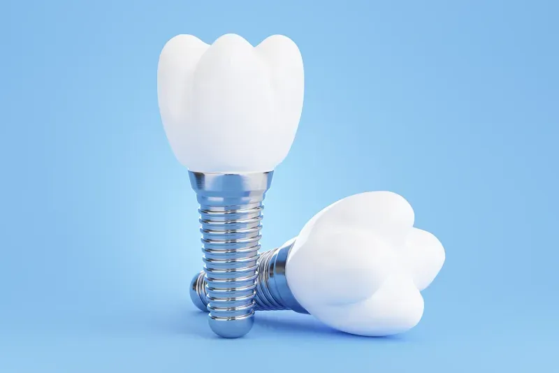 Dental Implant vs. Bridge: The Best Solution for Your Smile
