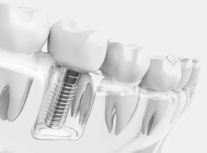 Dental Implants in Gainesville, FL: The Superior Path to a Permanent Smile