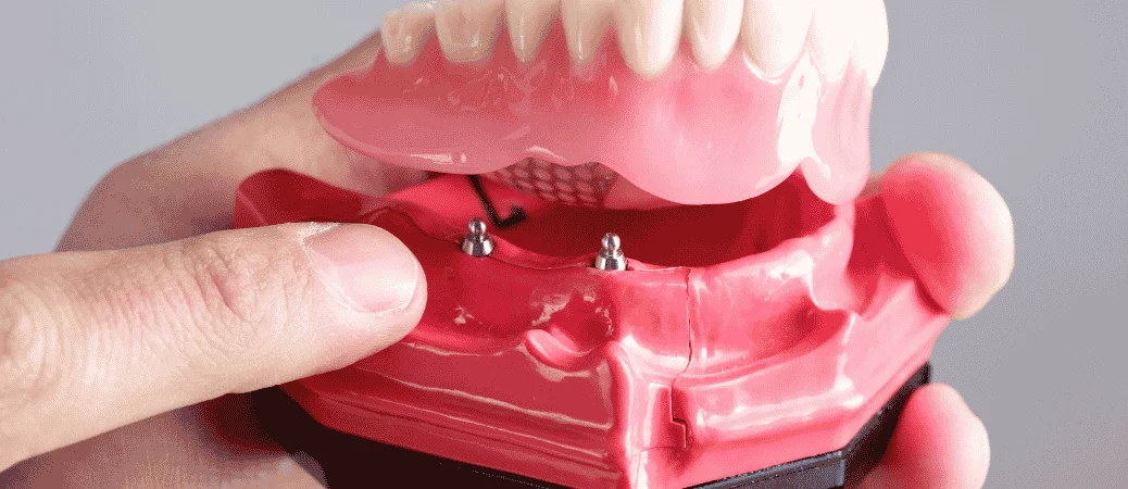 Denture vs Implant-Supported Denture: Which Costs Less Long Term?