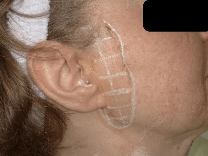 Frey’s Syndrome Treatment