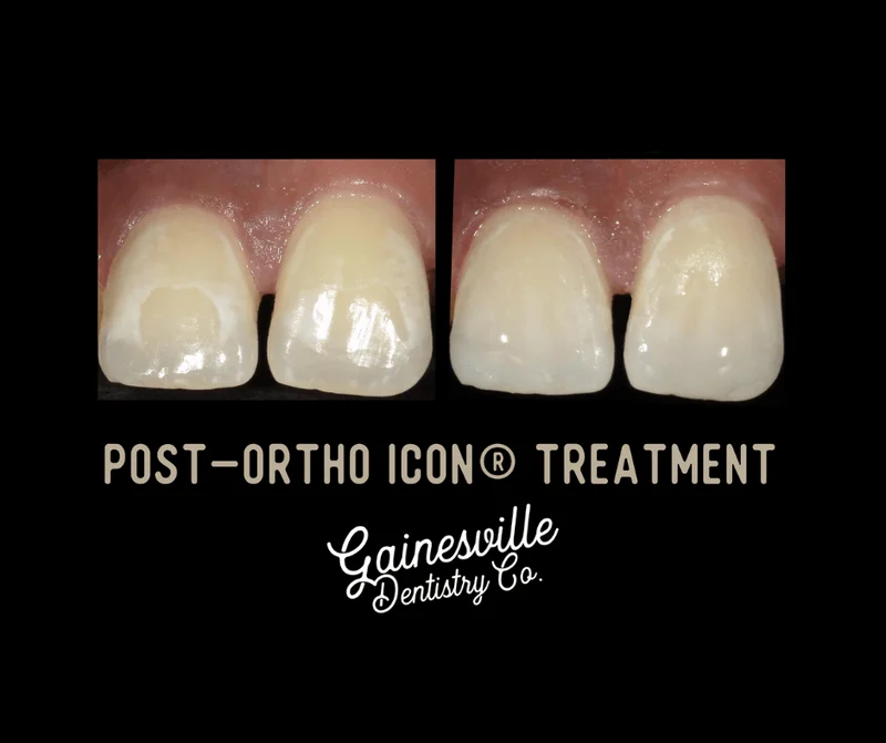Icon Treatment for White Spot Lesions
