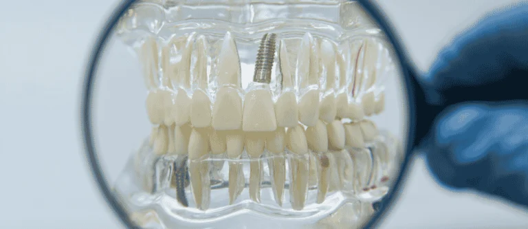 loose dental implant