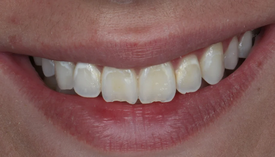 smile gallery 02 before