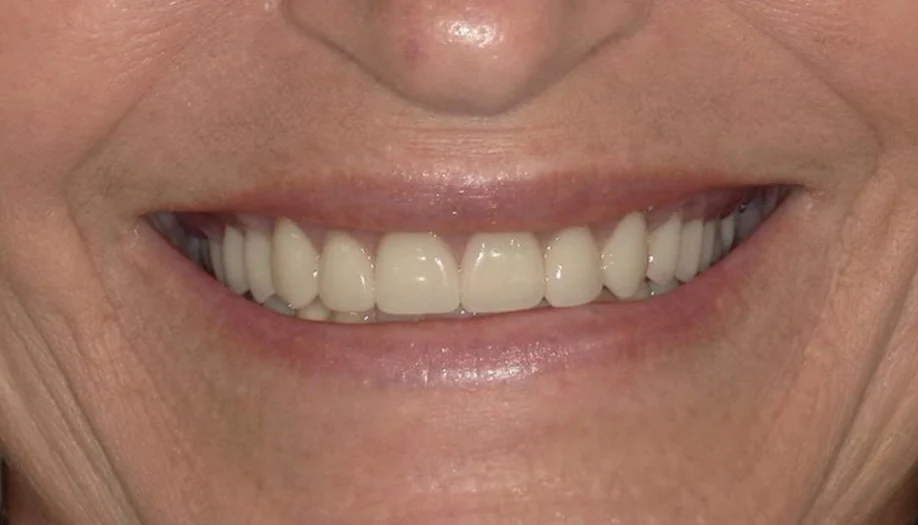smile gallery 03 after