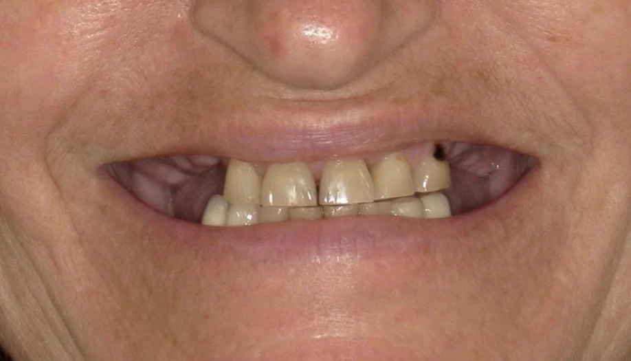 smile gallery 03 before