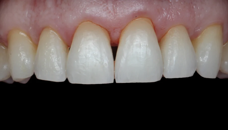 smile gallery 04 before