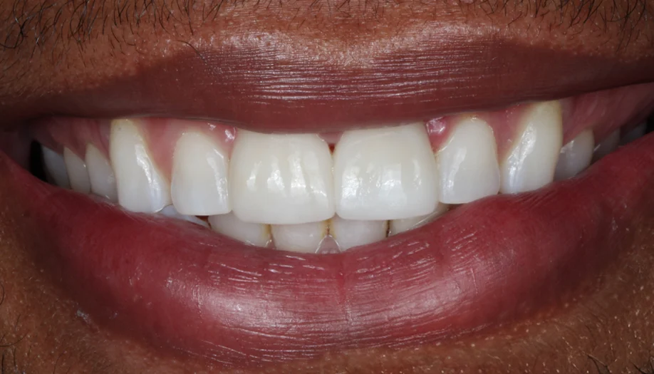 smile gallery 05 after