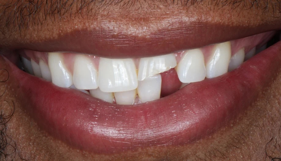 smile gallery 05 before