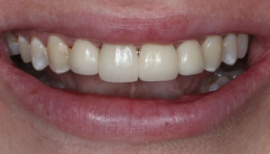 smile gallery 06 after