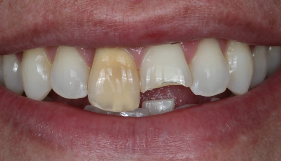 smile gallery 07 before