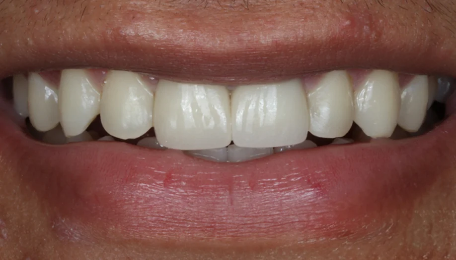 smile gallery 10 after