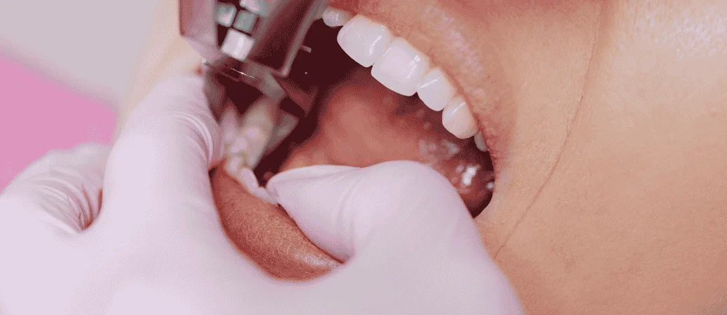 How to Know If You Need a Tooth Extraction or a Root Canal
