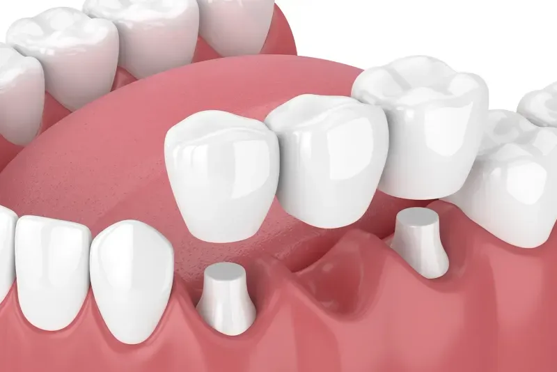 What is a Dental Bridge?