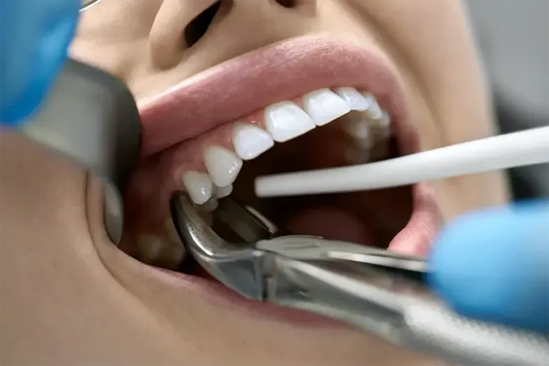 What to Eat After Wisdom Teeth Removal