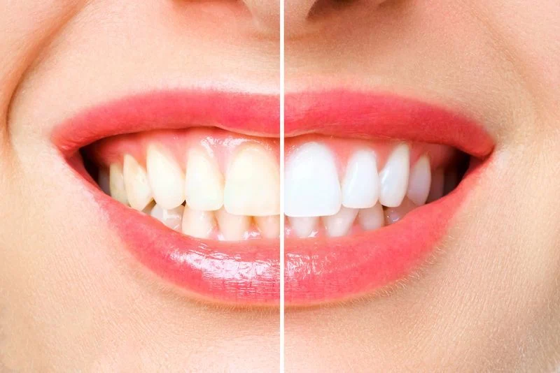 Which Teeth Whitening Works The Best